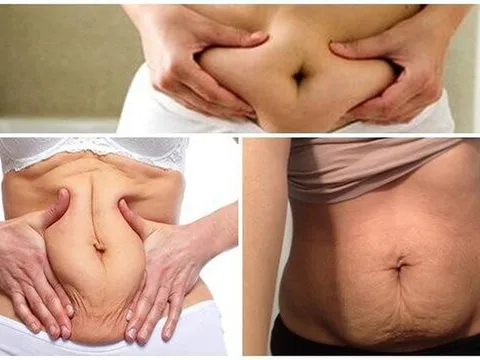 Cách khắc phục hiệu quả da bụng chùng nhão chị em sau sinh nhất định phải thực hiện