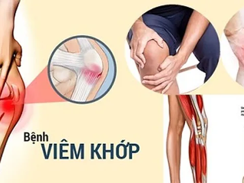 Thảo dược `khắc tinh` viêm đa khớp