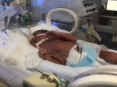 Cập nhật mới nhất về sức khỏe người mẹ ung thư giai đoạn cuối và em bé Bình An