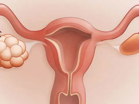Dấu hiệu có thể bạn đã bị đa nang buồng trứng