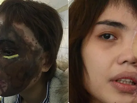 Hành trình 5 tháng tái tạo gương mặt cho cô gái bị chồng sắp cưới tạt axit