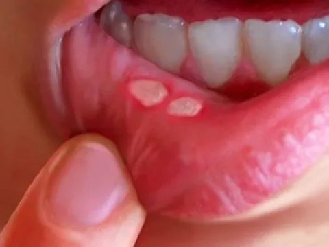 Nhiệt miệng ngày nắng-hãy thử ngay những bài thuốc dân gian sau
