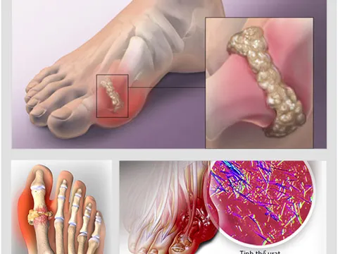Bất ngờ đỡ bệnh gút nhờ uống 'ké' bài thuốc Nam người Dao chữa xương khớp của vợ
