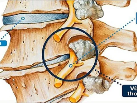 Nhờ bài thuốc Nam người Dao, cựu chiến binh đẩy lùi chứng thoái hóa cột sống 15 năm sau 7 tháng