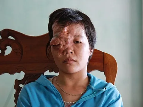 Xót xa cô gái Hà Tĩnh phải nghỉ học từ năm lên 9 vì khối u quái ác trên mặt