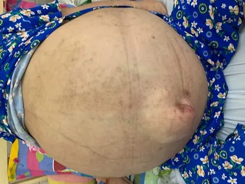 Bác sĩ 'liều' giải cứu cô gái 19 tuổi mang khối u nặng 50 kg, bụng to vượt mặt