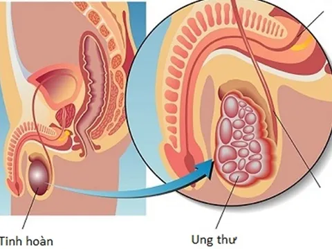 Ung thư tinh hoàn có thể chữa khỏi nếu phát hiện sớm