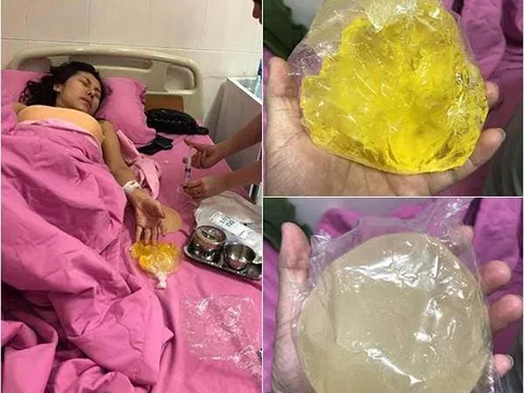 Cô gái gặp biến chứng sau nâng ngực trên máy bay: Bác sĩ khẳng định... 'không có chuyện vỡ túi ngực'