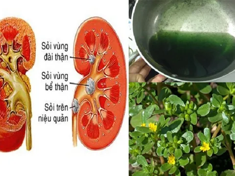 Trị bệnh sỏi thận bằng những vị thuốc Nam quanh nhà