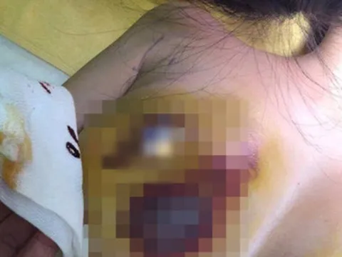 Cô gái 18 tuổi hôn mê 3 năm sau nâng cấp 'vòng 1': Phẫu thuật nâng ngực có thể gặp tai biến gì?