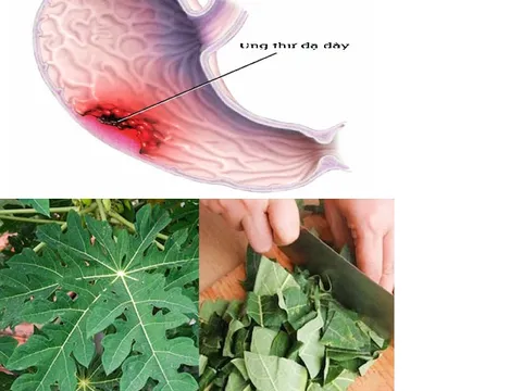 Cây thuốc Nam trong dân gian có tác dụng trong việc điều trị bệnh ung thư dạ dày