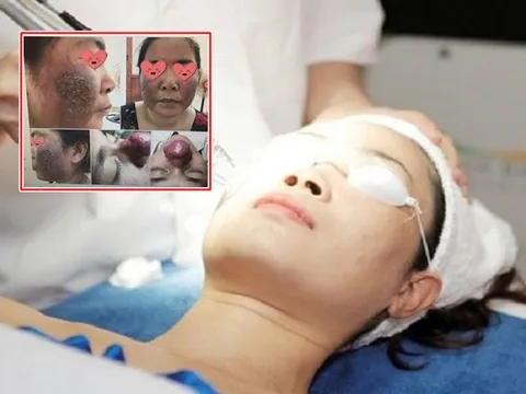 Hãi hùng gương mặt 'tanh bành' sau khi bắn nám bằng laser: Làm đẹp da bằng laser sao mới an toàn?