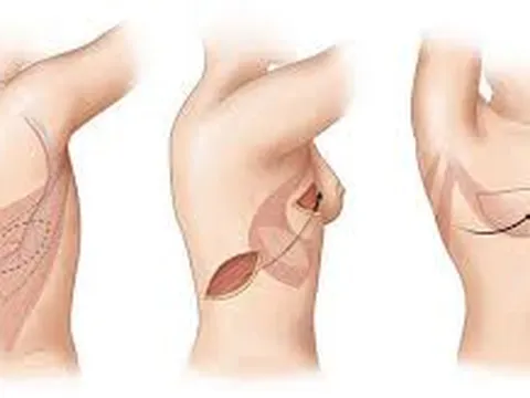 Bệnh viện Đại học Y tái tạo vú cho bệnh nhân ung thư bằng vạt da mỡ bụng