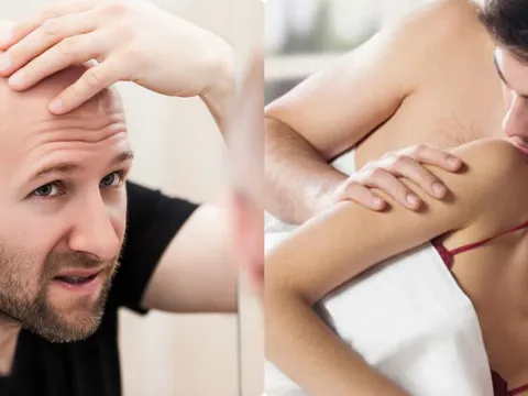 Thực hư chuyện nam giới hói đầu do 'ham sex'