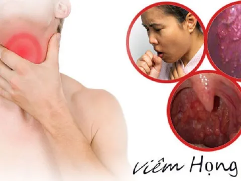 Bài thuốc Đông y chữa viêm họng an toàn và hiệu quả