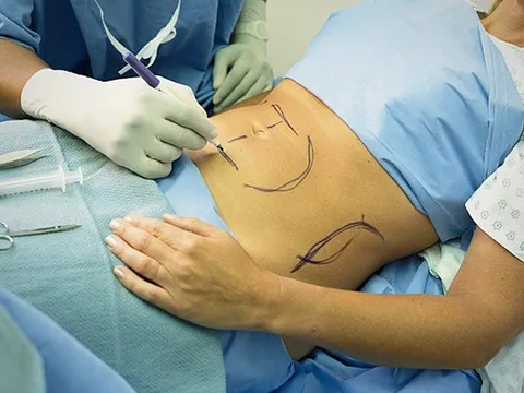 Tại sao có thể mất mạng vì hút mỡ bụng?
