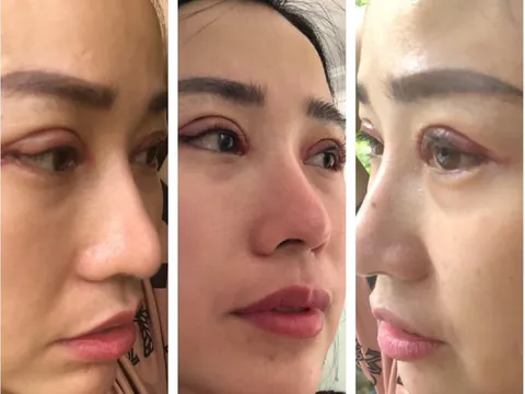 Bị tố phẫu thuật thẩm mỹ làm hỏng mắt, bác sỹ Vũ Văn Vương thách khách kiện