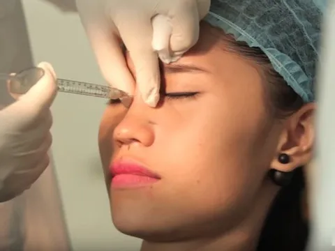 Vì sao chuyên gia cảnh báo chị em không nên nâng mũi bằng tiêm filler?