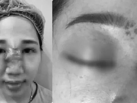 Những ca biến chứng kinh hoàng do tiêm filler nâng mũi: Từ nhiễm trùng, hoại tử đến mù mắt