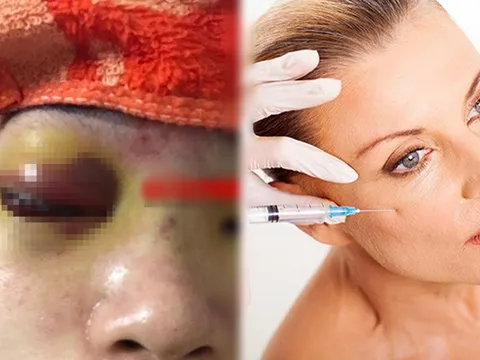 Vì sao nâng mũi bằng tiêm filler có thể gây mù mắt?