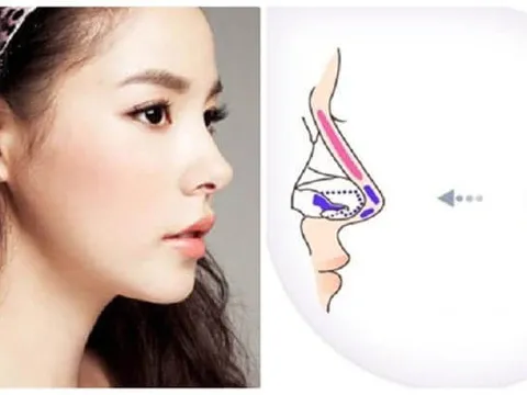 So sánh ưu nhược điểm các phương pháp nâng mũi phổ biến nhất hiện nay