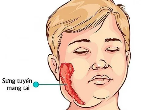 Những bài thuốc dân gian điều trị chứng quai bị hiệu quả