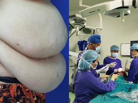 Phẫu thuật thu nhỏ bụng “siêu khủng” cho người phụ nữ 90kg: Nên chọn cách hút mỡ an toàn