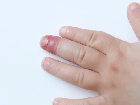 Chín mé là gì? Dấu hiệu cho thấy bạn đã bị chín mé
