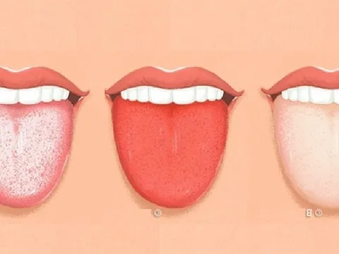 Nhìn lưỡi đoán bệnh theo quan điểm Đông y