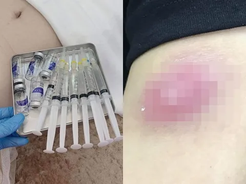 Chi 7 triệu tiêm tan mỡ ở spa, cô gái 28 tuổi khóc thét vì biến chứng đáng sợ