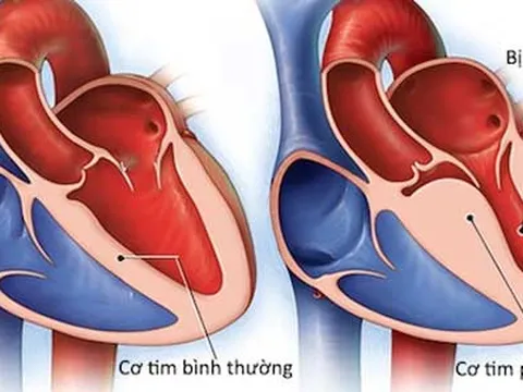 Thực hư thông tin loại virus lạ có tên 'viêm cơ tim' gây chết người hàng loạt
