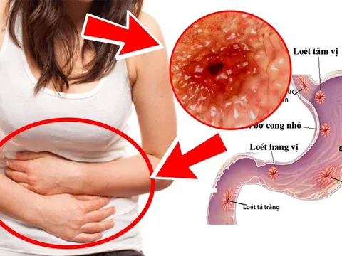 Nếu đang bị đau dạ dày, bạn nhất định phải cảnh giác 5 biến chứng nguy hiểm này