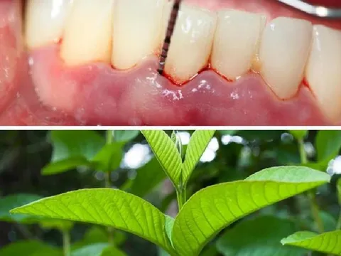 Những thảo dược tự nhiên 'đánh bay' chứng viêm lợi, cải thiện hơi thở có mùi