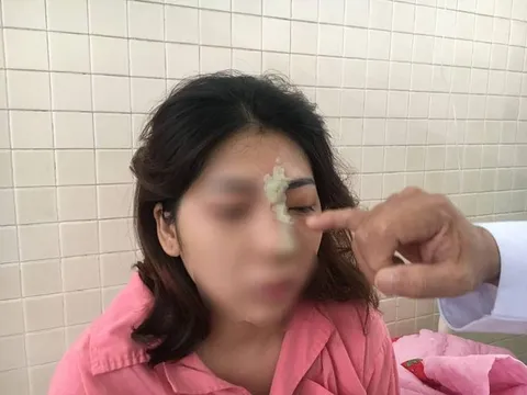 Lại thêm 1 trường hợp cô gái 21 tuổi mù mắt vì tiêm filler nâng mũi