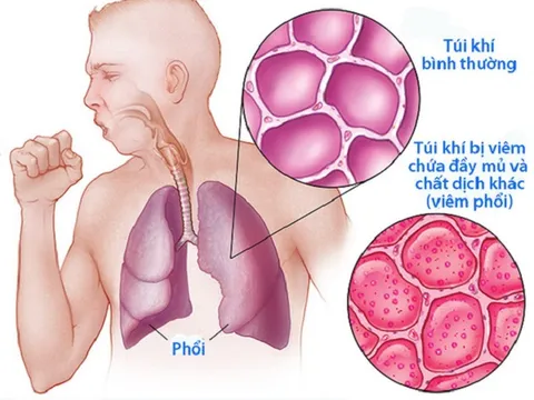 Viêm phổi đang vào mùa, đây là những dấu hiệu nhận biết sớm căn bệnh nguy hiểm này