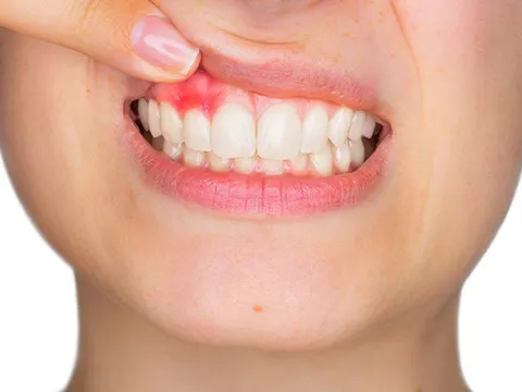 Thoát nỗi ám ảnh viêm lợi, sưng mộng răng, tụt chân răng với bài thuốc Nam hiệu quả