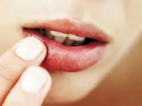 Đẩy lùi nhiệt miệng, đau răng chỉ sau 2 ngày nhờ bài thuốc ngậm hoàn toàn từ thảo dược