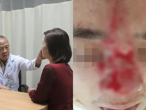 Cảnh báo: Lại thêm trường hợp nam thanh niên 27 tuổi mù mắt, hoại tử vì tiêm filler nâng mũi
