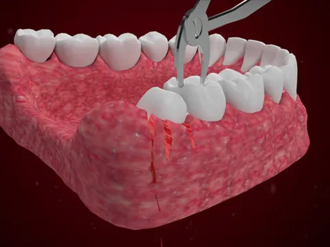 Nhổ răng khôn có đau không? Các phương pháp nhổ răng an toàn nhất hiện nay