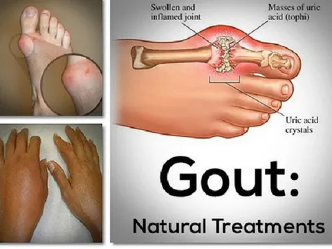 Cách xoa bóp bấm huyệt chữa bệnh gút