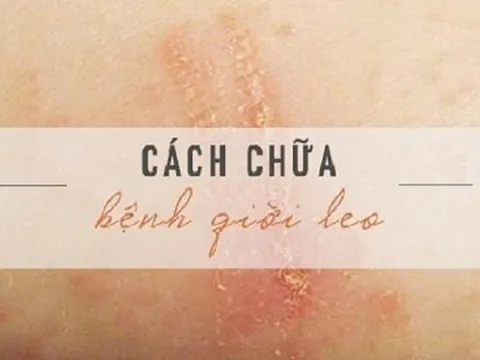 Bài thuốc Nam điều trị bệnh 'giời leo' hiệu quả tại nhà