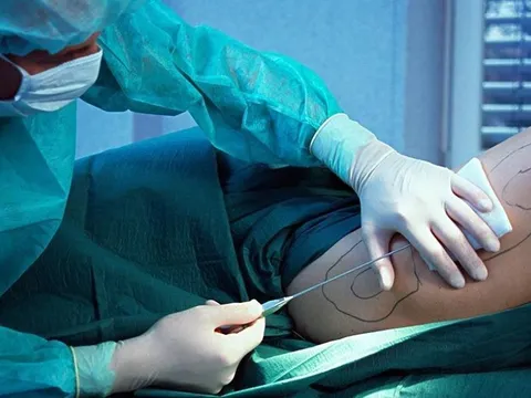 Nam thanh niên 31 tuổi phải nhập viện cấp cứu vì... hút mỡ đùi