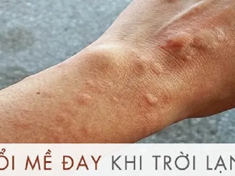 Bài thuốc dân gian chữa chứng nổi mề đay khi trời lạnh 