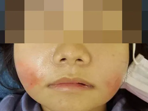 Tiêm filler mặt trẻ hóa ở 1 spa tư nhân, cô gái nhập viện cầu cứu vì hai má nóng đỏ, sưng đau
