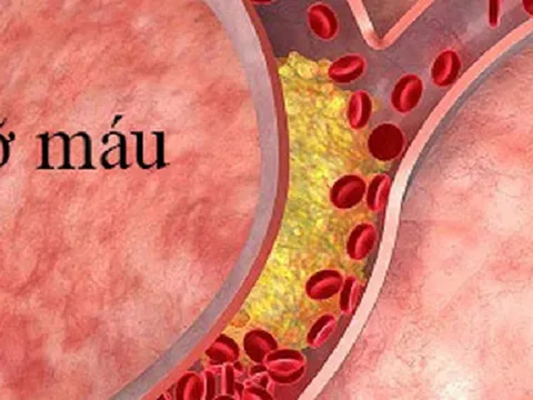 “Quét sạch” mỡ máu nhờ loại thức uống rẻ tiền