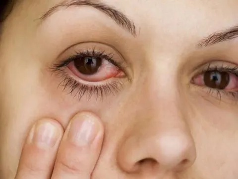 Bệnh đau mắt đỏ nên kiêng ăn gì?