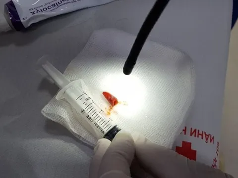 Ho khù khụ suốt 2 tháng vì miếng ớt kẹt trong đường thở