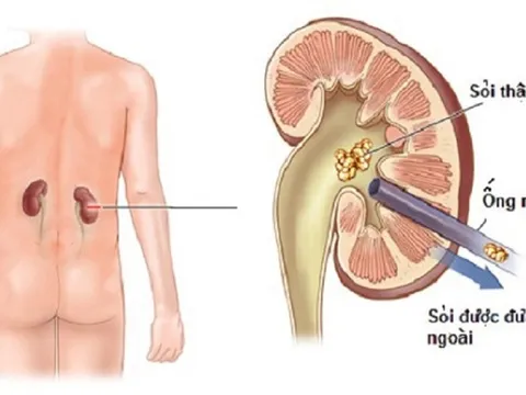 Cách bấm huyệt chữa bệnh sỏi thận