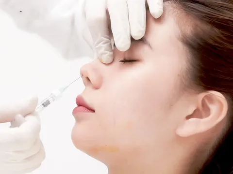 Chi 1,5 triệu tiêm filler nâng mũi, thiếu nữ 15 tuổi mù vĩnh viễn mắt trái 
