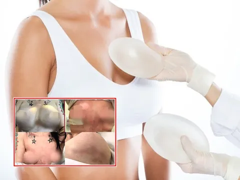 Chi tiền xuất ngoại nâng cấp 'vòng 1', cô gái phải đau đớn cắt bỏ 2 bên ngực 